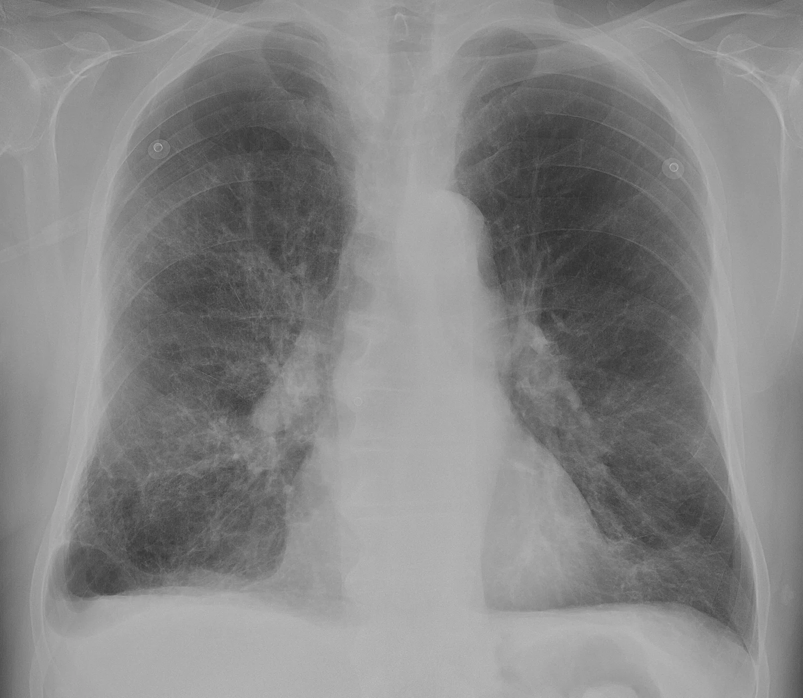 Röntgen-Thorax im anterior-posterioren Strahlengang: große, strahlendurchlässige Lungen mit tief stehenden, abgeflachten Zwerchfellkuppeln.