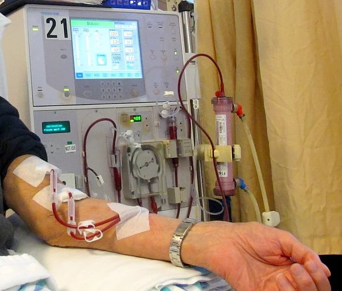 Foto einer laufenden Hämodialyse: Vom Unterarm führen Blutschläuche zum Dialysegerät mit Blutpumpe und Dialysator.