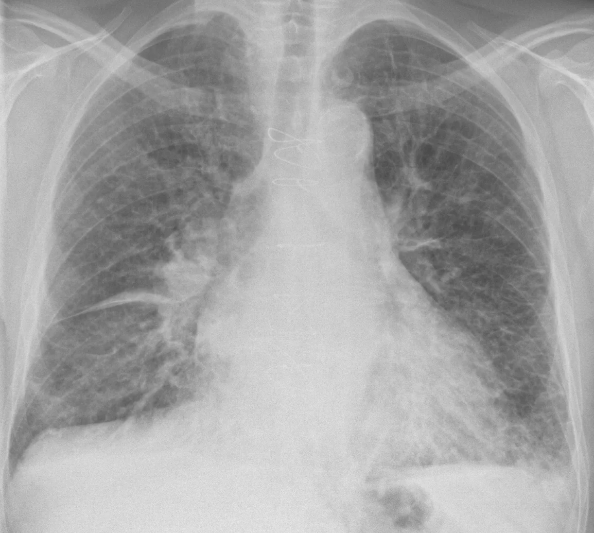 Röntgenaufnahme des Thorax von vorn: vergrößerter Herzschatten, nach oben umverteilte Lungengefäße, feine waagerechte Kerley-B-Linien im linken Unterfeld am Rand der Lunge und etwas Flüssigkeit im rechten Interlobärspalt; Drahtcerclagen am Brustbein nach früherer Herzoperation.