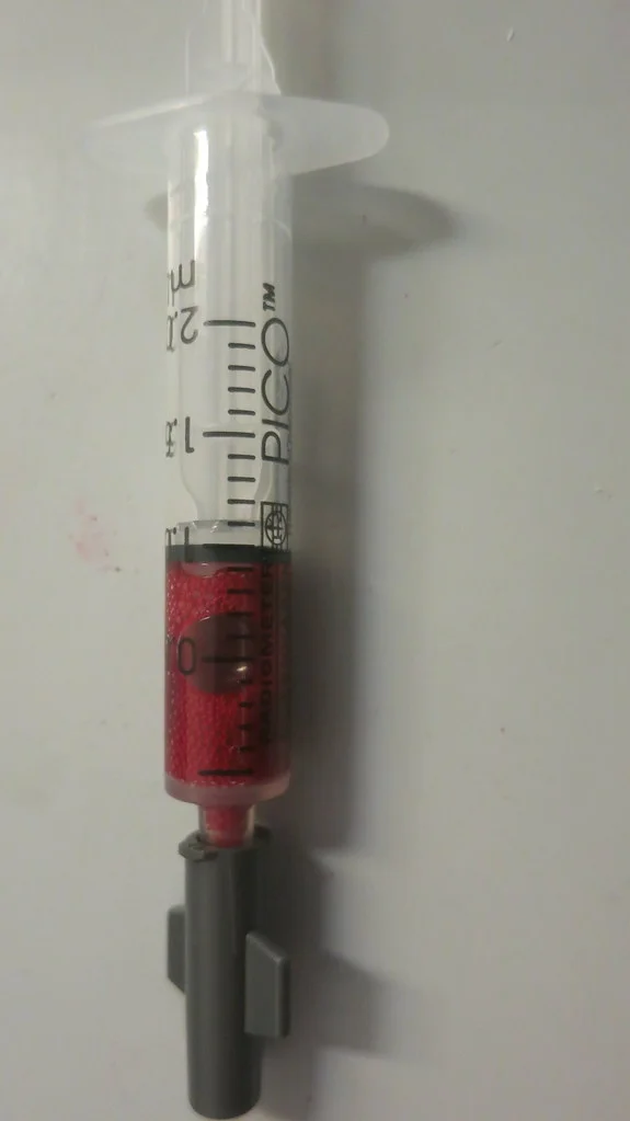 Eine BGA-Spritze mit hellrotem arteriellem Blut; die Spitze ist mit einer grauen Verschlusskappe abgedichtet.