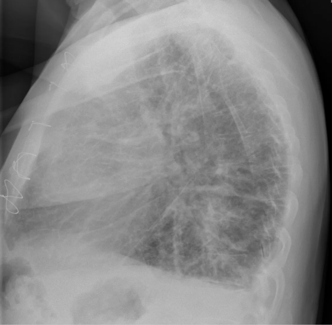 Seitliche Röntgenaufnahme des Thorax eines älteren Patienten: großer Herzschatten und vermehrte streifige Lungenzeichnung; Drahtcerclagen am Brustbein nach früherer Herzoperation.