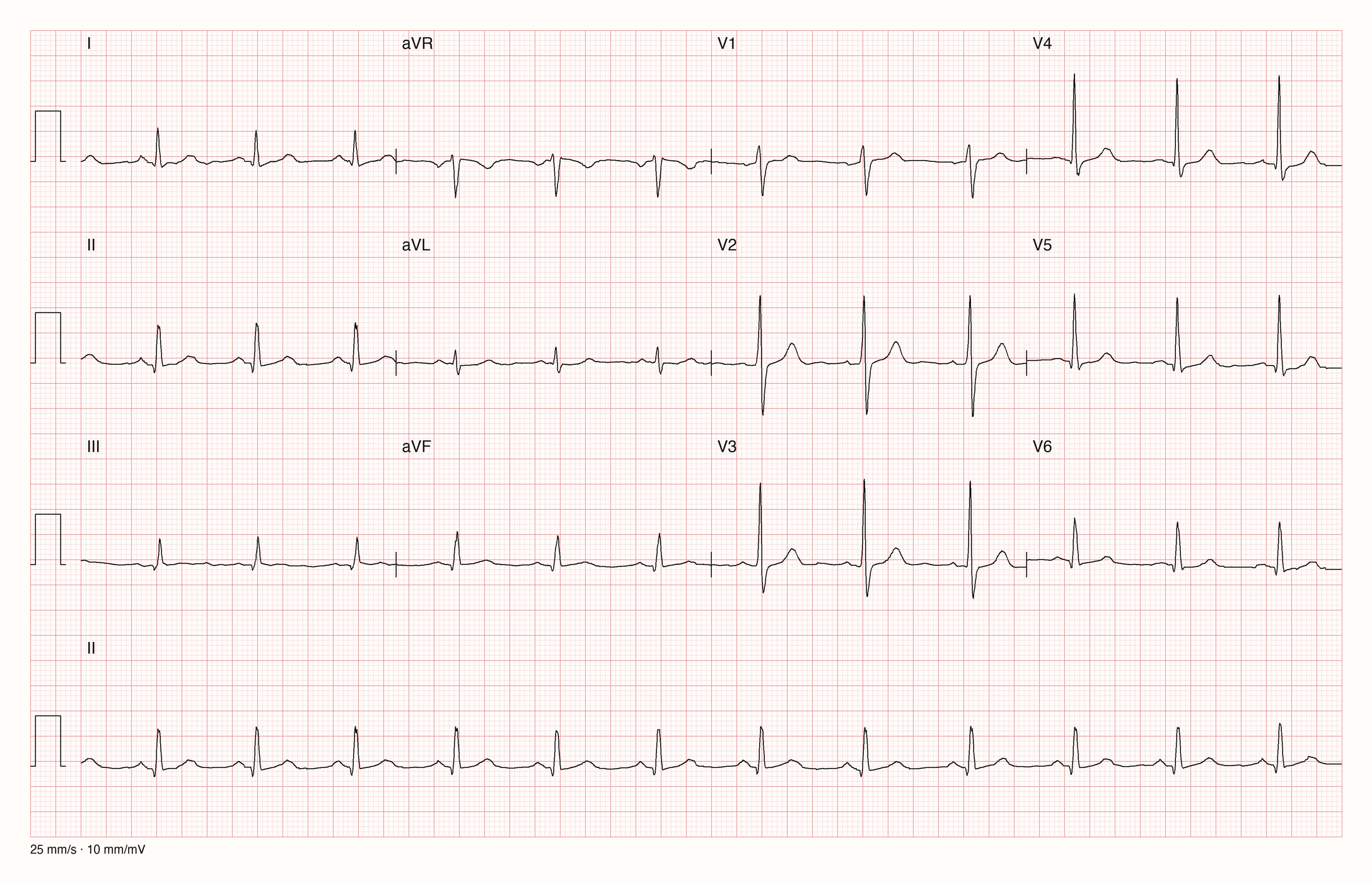 12-Kanal-EKG mit durchgehendem Rhythmusstreifen II; 25 mm/s und 10 mm/mV.