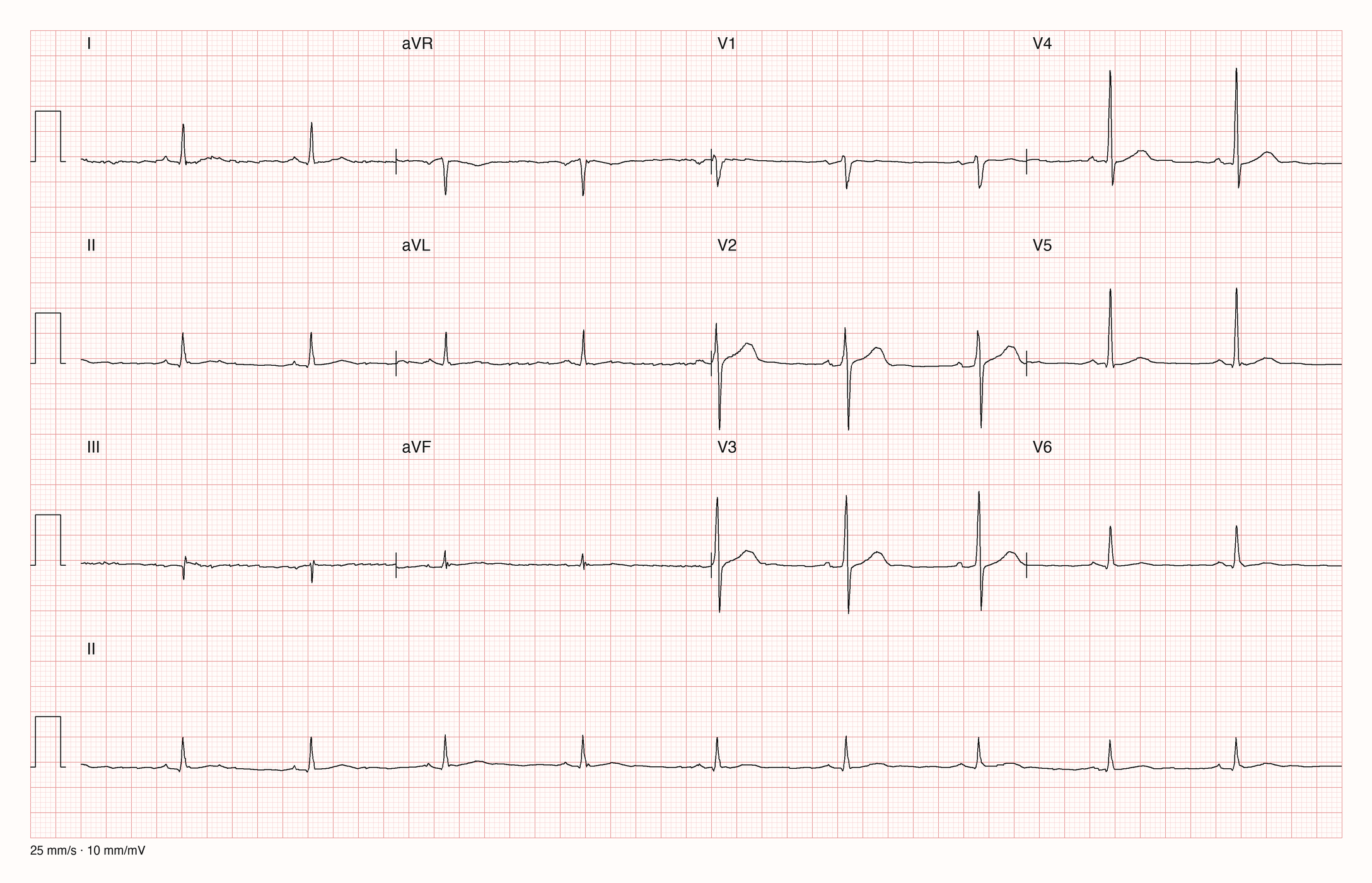 12-Kanal-EKG mit durchgehendem Rhythmusstreifen II; 25 mm/s und 10 mm/mV.