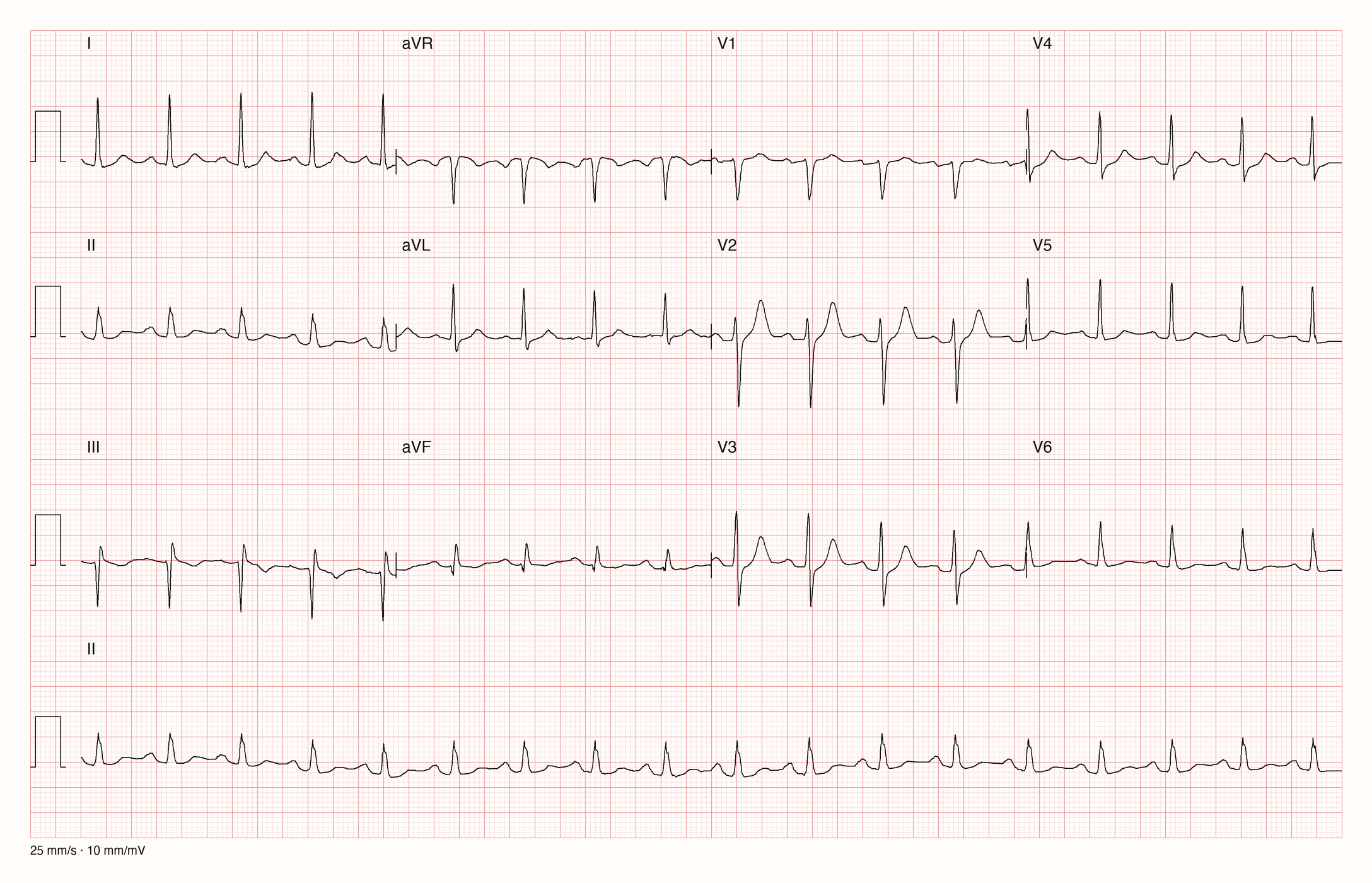 12-Kanal-EKG mit durchgehendem Rhythmusstreifen II; 25 mm/s und 10 mm/mV.