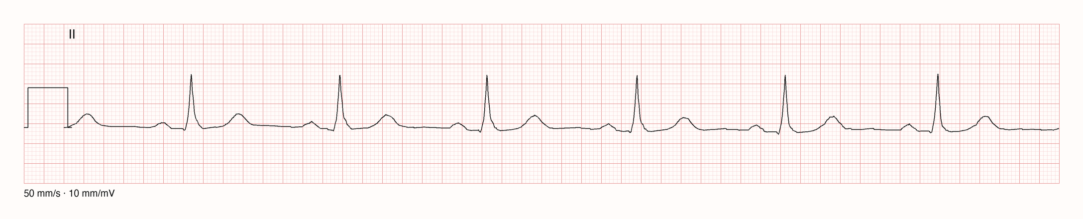 Echter EKG-Rhythmusstreifen, Ableitung II, 5 Sekunden bei 50 mm/s und 10 mm/mV. Sechs regelmäßige, schmale QRS-Komplexe; vor jedem QRS-Komplex eine kleine positive P-Welle, nach jedem eine positive T-Welle.