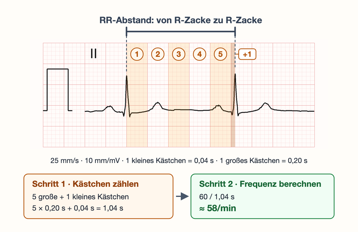 Echter Rhythmusstreifen Ableitung II mit zwei R-Zacken. Die erste R-Zacke liegt auf einer dicken Linie; zwischen beiden R-Zacken sind fünf große Kästchen nummeriert und abwechselnd getönt, danach ist ein zusätzliches kleines Kästchen mit „+1“ hervorgehoben. Eine Klammer über dem Streifen markiert den RR-Abstand. Darunter zwei Rechenkästen: 5 große + 1 kleines Kästchen = 5 × 0,20 s + 0,04 s = 1,04 s; 60 / 1,04 s ≈ 58/min.