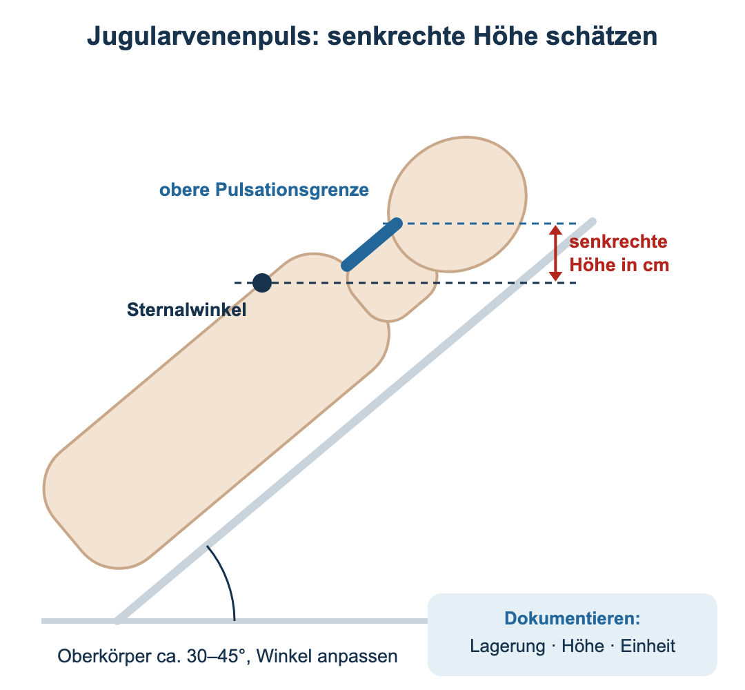 Seitliches Schema einer liegenden Person mit etwa 40° erhöhtem Oberkörper. Markiert sind der Sternalwinkel und die obere Pulsationsgrenze der Halsvene; zwischen zwei waagerechten Linien zeigt ein roter Doppelpfeil die senkrechte Höhe.