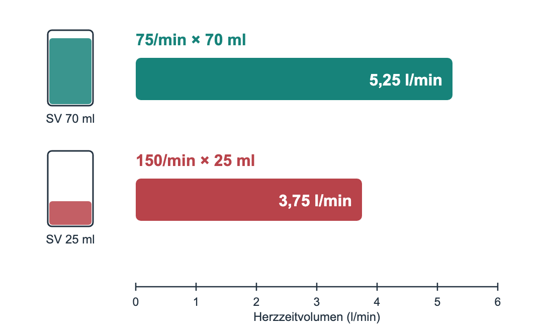 Balkendiagramm mit zwei Szenarien. Oben 75 pro Minute mal 70 Milliliter, Balken bis 5,25 Liter pro Minute; daneben ein gut gefülltes Gefäß mit der Beschriftung SV 70 ml. Unten 150 pro Minute mal 25 Milliliter, kürzerer Balken bis 3,75 Liter pro Minute; daneben ein nur wenig gefülltes Gefäß mit SV 25 ml. Darunter eine Skala von 0 bis 6 Liter pro Minute.