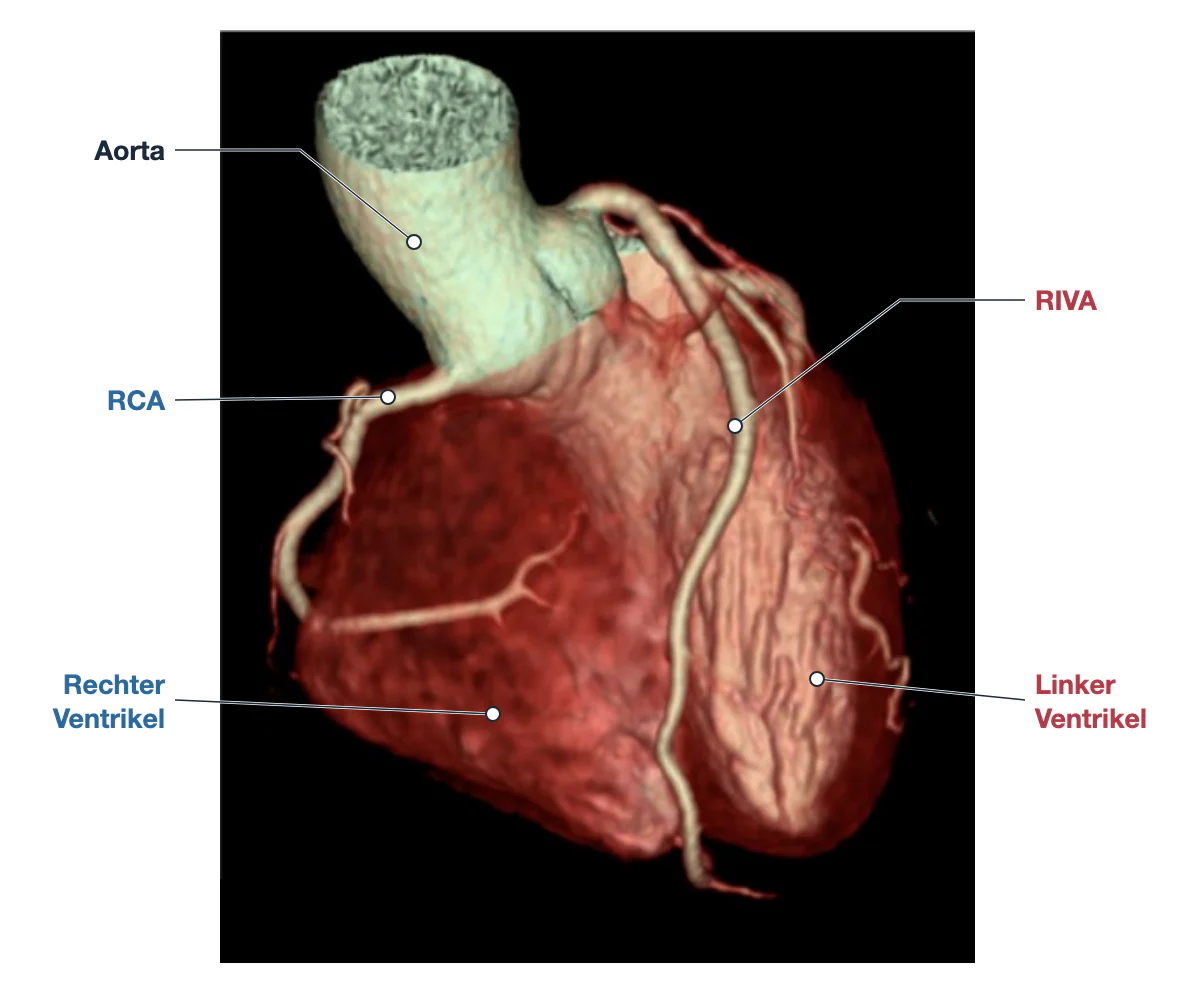 Dreidimensionale CT-Darstellung eines Herzens von vorn mit deutscher Beschriftung: Aorta, rechte Koronararterie im rechten Vorhof-Kammer-Übergang, RIVA in der vorderen Furche zwischen rechtem und linkem Ventrikel bis zur Herzspitze.