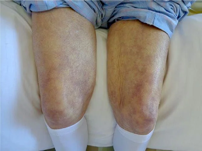 Beide Knie und distalen Oberschenkel einer liegenden Person von vorn; die Haut zeigt eine fleckige, netzartige violett-livide Zeichnung, am deutlichsten über und um die Kniescheiben.