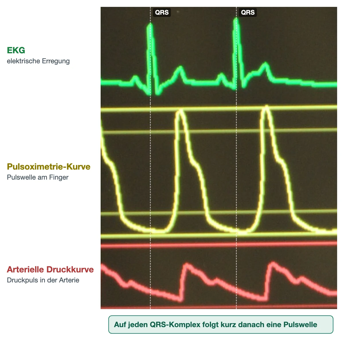 Echter Ausschnitt eines Überwachungsmonitors auf dunklem Grund mit drei übereinanderliegenden Kurven: oben grüne EKG-Kurve mit zwei schmalen QRS-Komplexen, darunter gelbe Pulsoximetrie-Kurve und rote arterielle Druckkurve. Gestrichelte Linien an den QRS-Komplexen zeigen, dass beide Pulswellen jeweils kurz danach ansteigen.