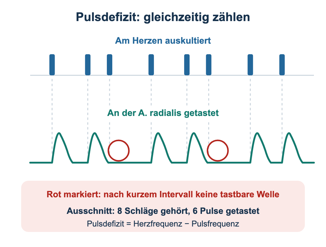Oben acht auskultierte Herzschläge als Balken, unten die gleichzeitig getastete Radialiskurve mit sechs Pulswellen; nach zwei sehr kurzen Schlagintervallen fehlt die periphere Welle (rot markiert).
