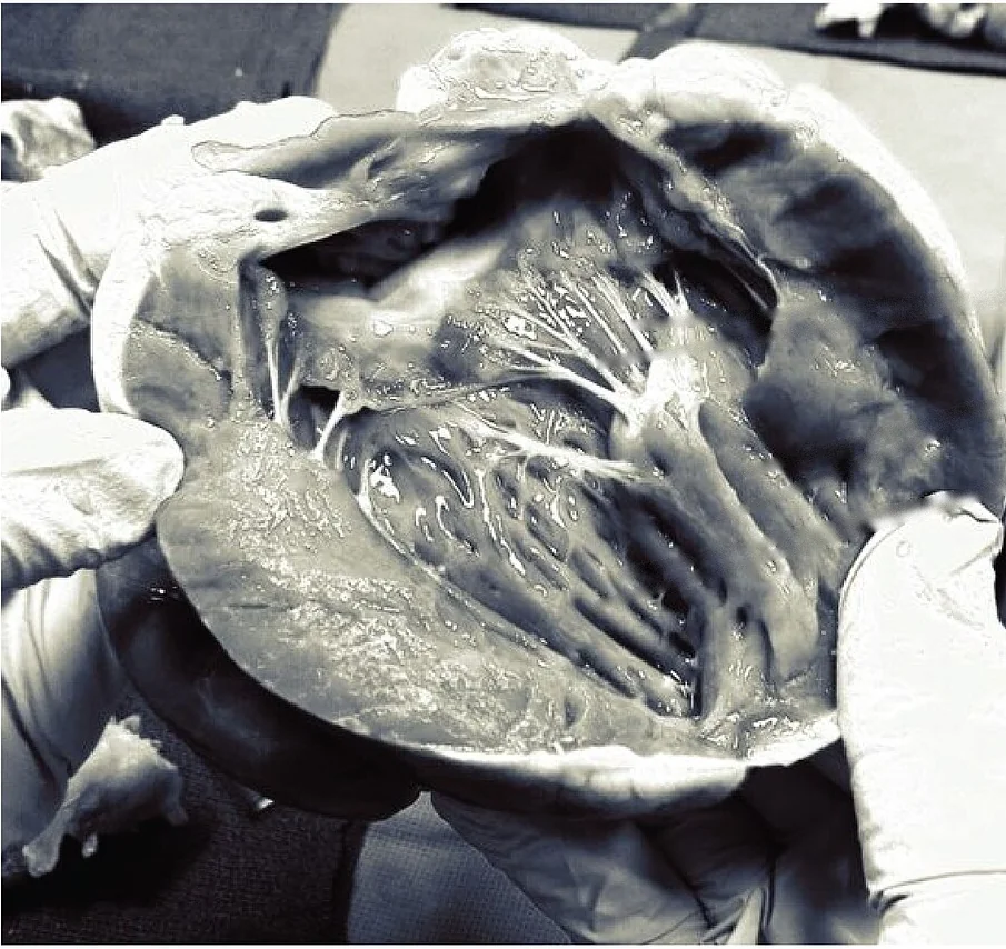 Echtes Präparatfoto in Graustufen: eine eröffnete Herzkammer, von Händen in Handschuhen gehalten. Von kegelförmigen Muskelvorsprüngen der Kammerwand ziehen zahlreiche feine weiße Fäden zu dünnen Klappensegeln; die Innenwand zeigt Muskelbälkchen.