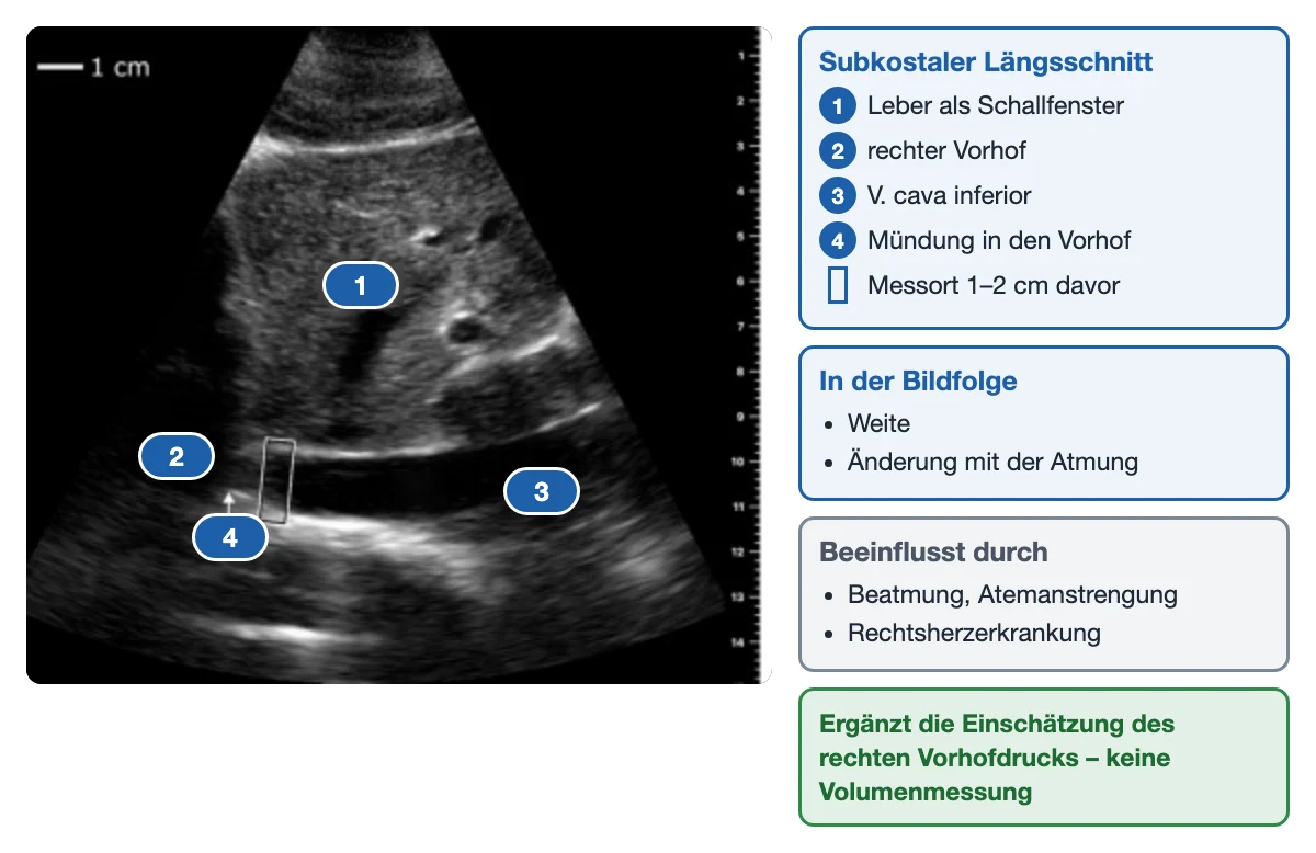 Echte Ultraschallaufnahme unterhalb des Rippenbogens im Längsschnitt mit nummerierten Markierungen: oben die Leber (1), links unten der rechte Vorhof (2), quer durch das Bild ein dunkles Band, die V. cava inferior (3), und ihre Mündung in den Vorhof (4) mit einem schmalen Rahmen kurz davor als Messort. Rechts daneben Kästen mit Legende, „In der Bildfolge: Weite, Änderung mit der Atmung“, „Beeinflusst durch Beatmung, Atemanstrengung, Rechtsherzerkrankung“ und der grünen Aussage „Ergänzt die Einschätzung des rechten Vorhofdrucks – keine Volumenmessung“.