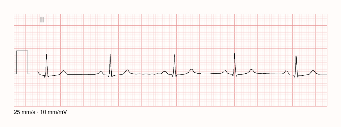 Ableitung II, fünf Sekunden Sinusrhythmus: vor jedem schmalen QRS eine positive P-Welle, danach eine positive T-Welle