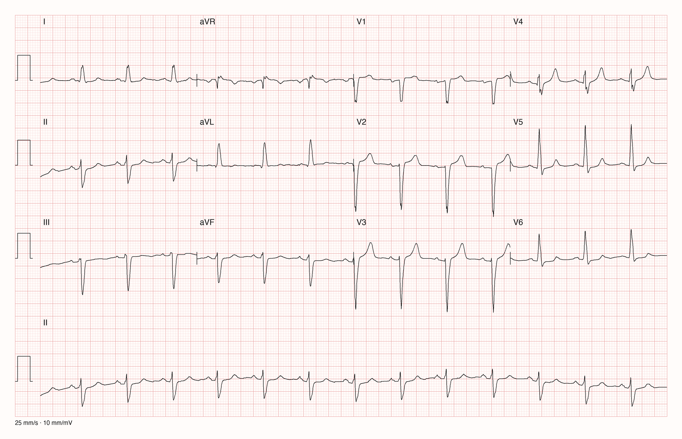 12-Kanal-EKG mit Rhythmusstreifen II: schmale QRS-Komplexe, in I und aVL überwiegend positiv, in II, III und aVF überwiegend negativ