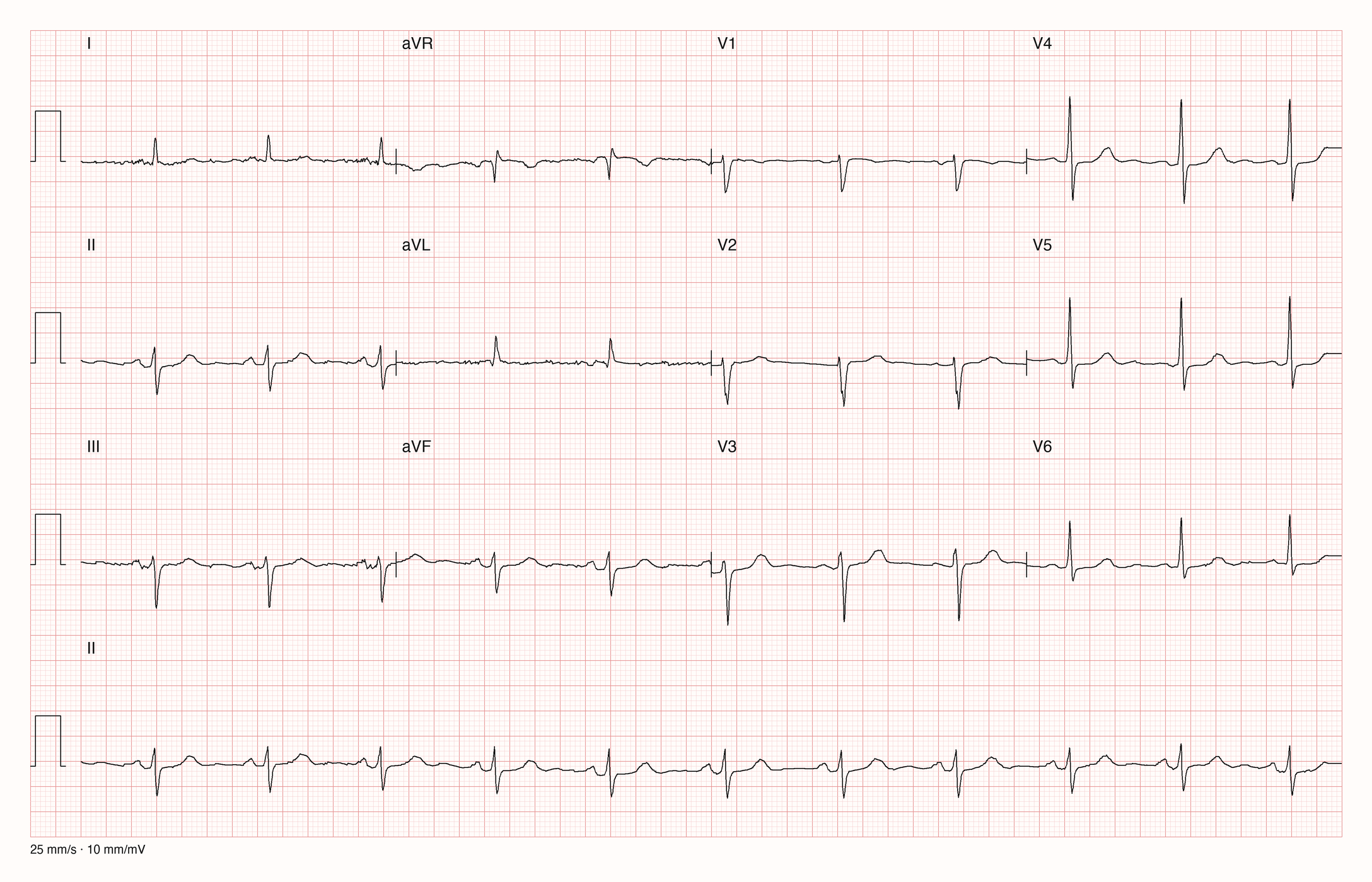 12-Kanal-EKG mit überwiegend positivem QRS in I und aVL und überwiegend negativem QRS in II, III und aVF
