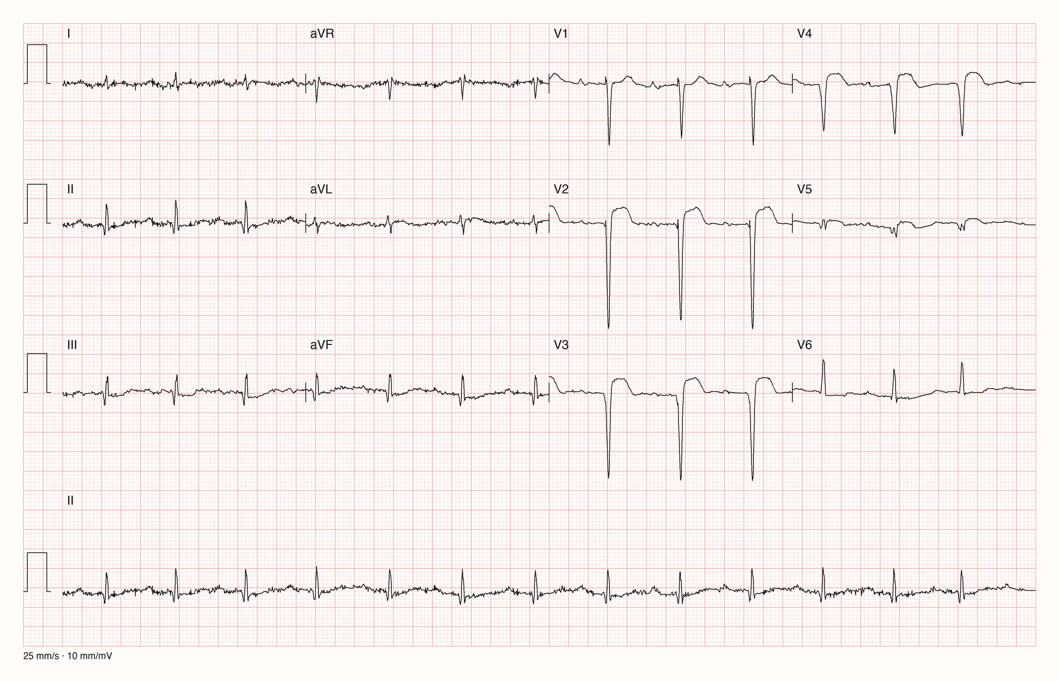 12-Kanal-EKG im Sinusrhythmus, etwa 80/min: QS-Komplexe in V1 bis V4 mit anhaltender ST-Hebung in V2 bis V4; sehr niedrige, verrauschte Extremitätenableitungen