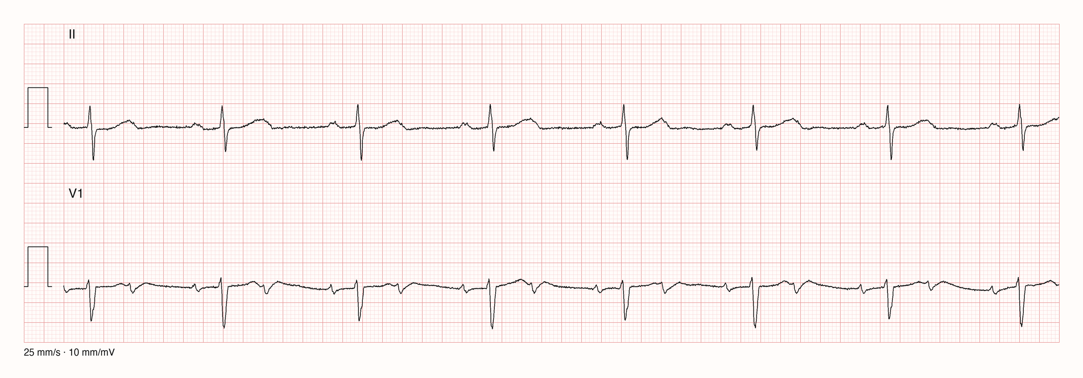 Zwei Rhythmusstreifen, Ableitung II und V1 über 10 Sekunden: regelmäßige schmale QRS-Komplexe etwa alle 1,3 Sekunden, vor jedem QRS eine P-Welle, eine zweite P-Welle jeweils am Ende der T-Welle ohne folgenden QRS
