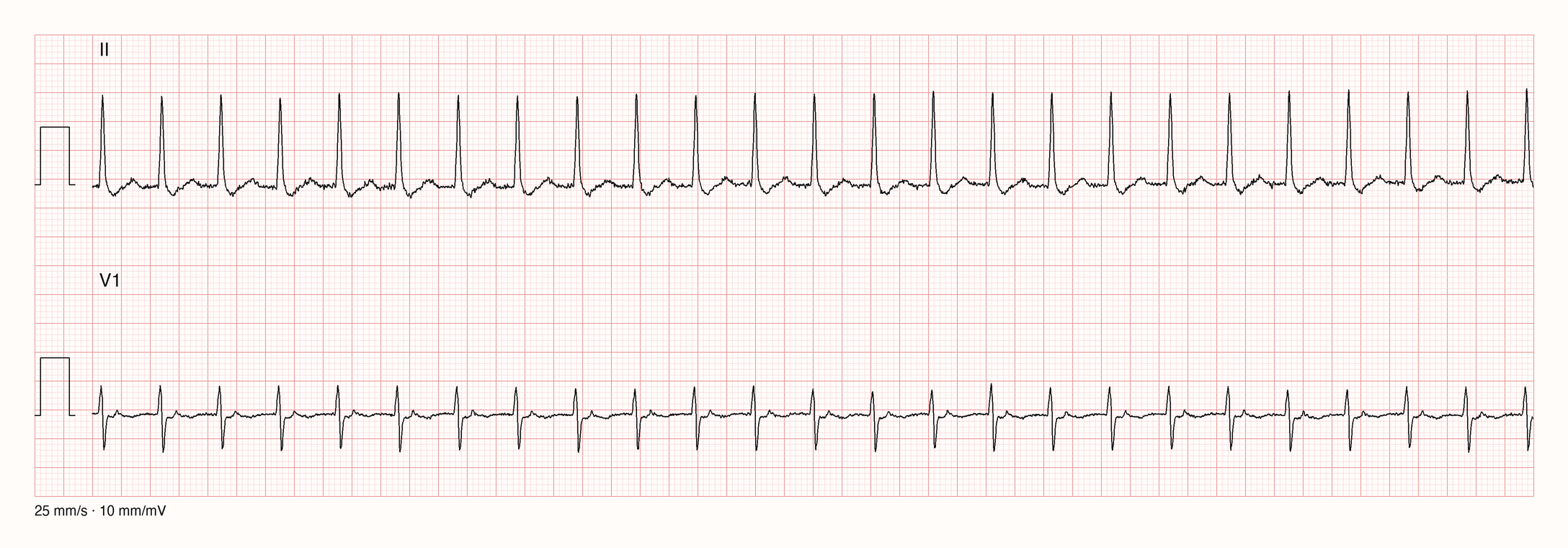 Ableitungen II und V1 über 10 s: 25 gleichförmige schmale QRS-Komplexe in exakt gleichen Abständen von etwa 0,41 s; regelmäßige Schmalkomplextachykardie um 145/min