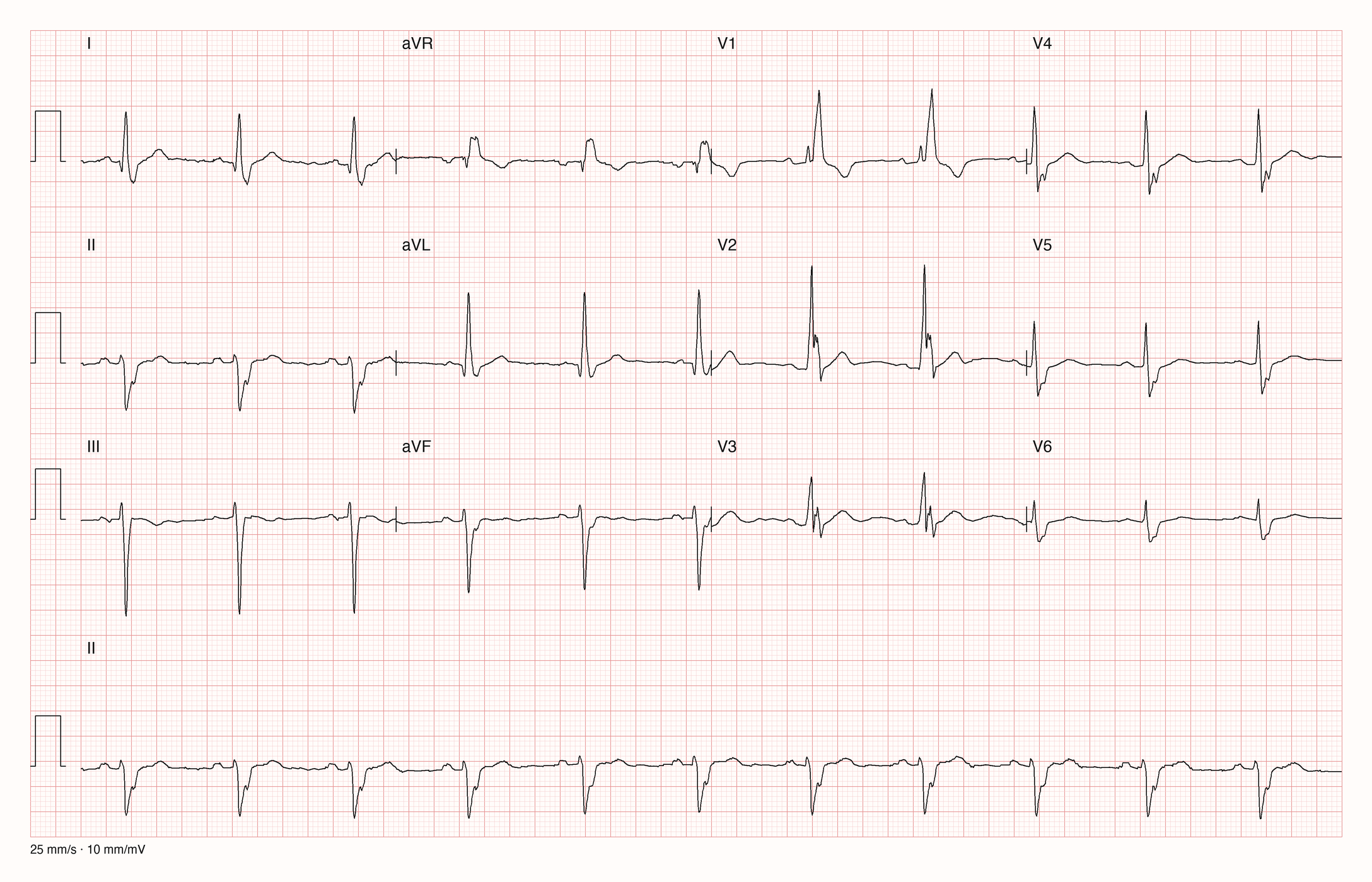 Ableitungen in 3×4-Anordnung mit II-Rhythmusstreifen: breite QRS-Komplexe mit rsR′ in V1 und breitem S in I und V6, dazu qR in aVL und rS mit tiefem S in II, III und aVF