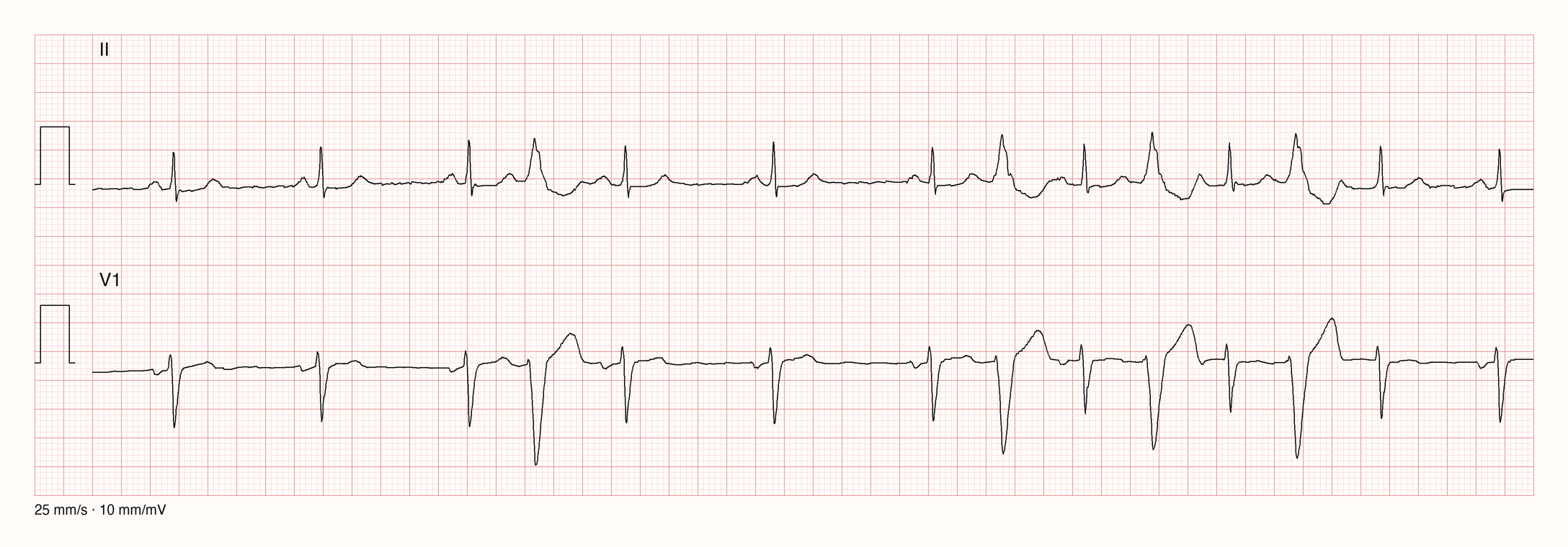 Ableitungen II und V1 über 10 s: Sinusrhythmus mit RR etwa 1,03 s; ab etwa 6 s wechseln Normalschlag und breite, vorzeitige, anders geformte Extrasystole regelmäßig ab; zwischen zwei Normalschlägen vergeht trotz Extrasystole etwa ein Grund-RR