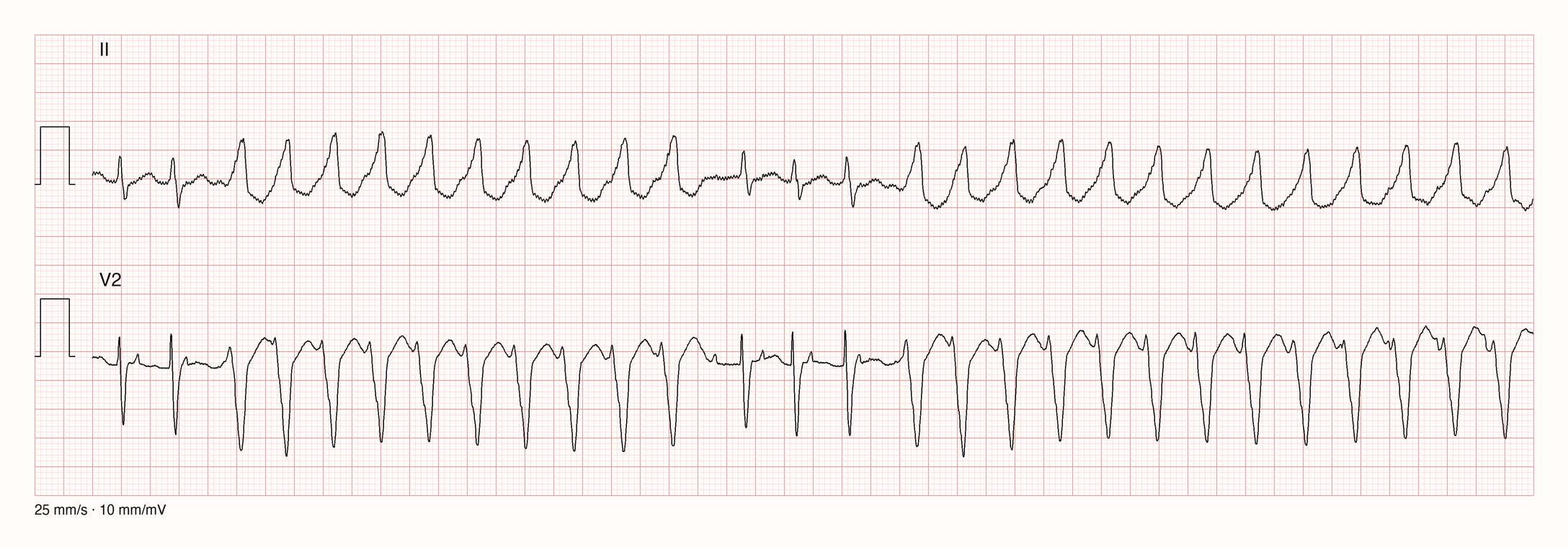 Ableitungen II und V2 über 10 s: zwei Salven einer regelmäßigen Breitkomplextachykardie um 180/min mit breiten QRS-Komplexen, tiefen QS-Zacken in V2 und gegensinniger Repolarisation; am Anfang zwei und in der Mitte drei schmale QRS-Komplexe