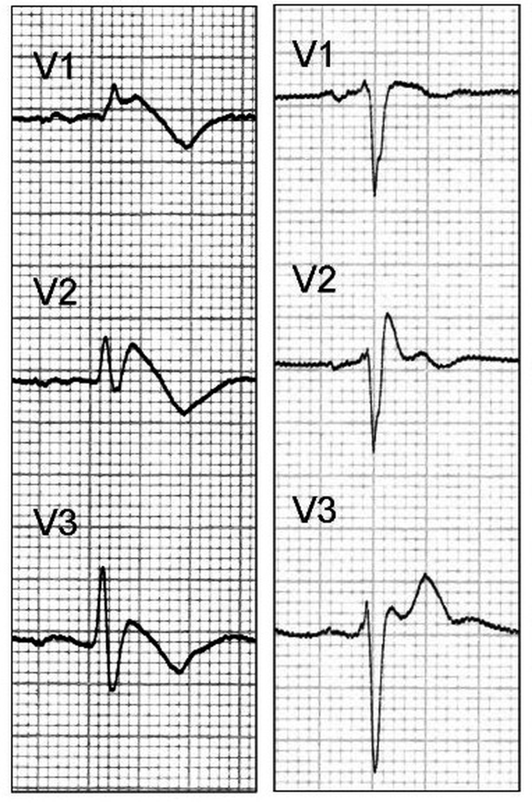 Ableitungen V1 bis V3 auf EKG-Papier in zwei Feldern: links gewölbte, abfallende ST-Hebung mit negativer T-Welle in V1 und V2; rechts sattelförmige ST-Hebung mit positivem T in V2