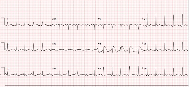 12-Kanal-EKG: regelmäßige Tachykardie um 125/min mit schmalen QRS-Komplexen; in V2 eine gewölbte, abfallende ST-Hebung, die in eine negative T-Welle übergeht; V1 und V3 zeigen diese Form nicht