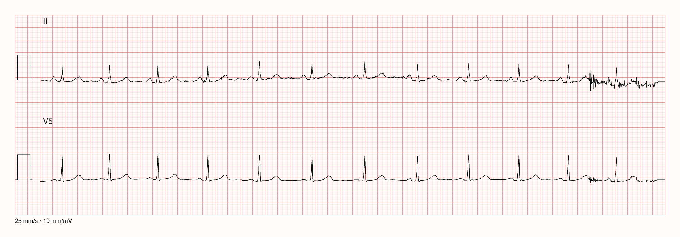 Ableitungen II und V5 über 10 s bei 25 mm/s und 10 mm/mV; regelmäßige QRS-Komplexe, in der letzten guten Sekunde überlagert eine grobe schnelle Störung beide Ableitungen gleichzeitig, ein QRS bleibt darin erkennbar