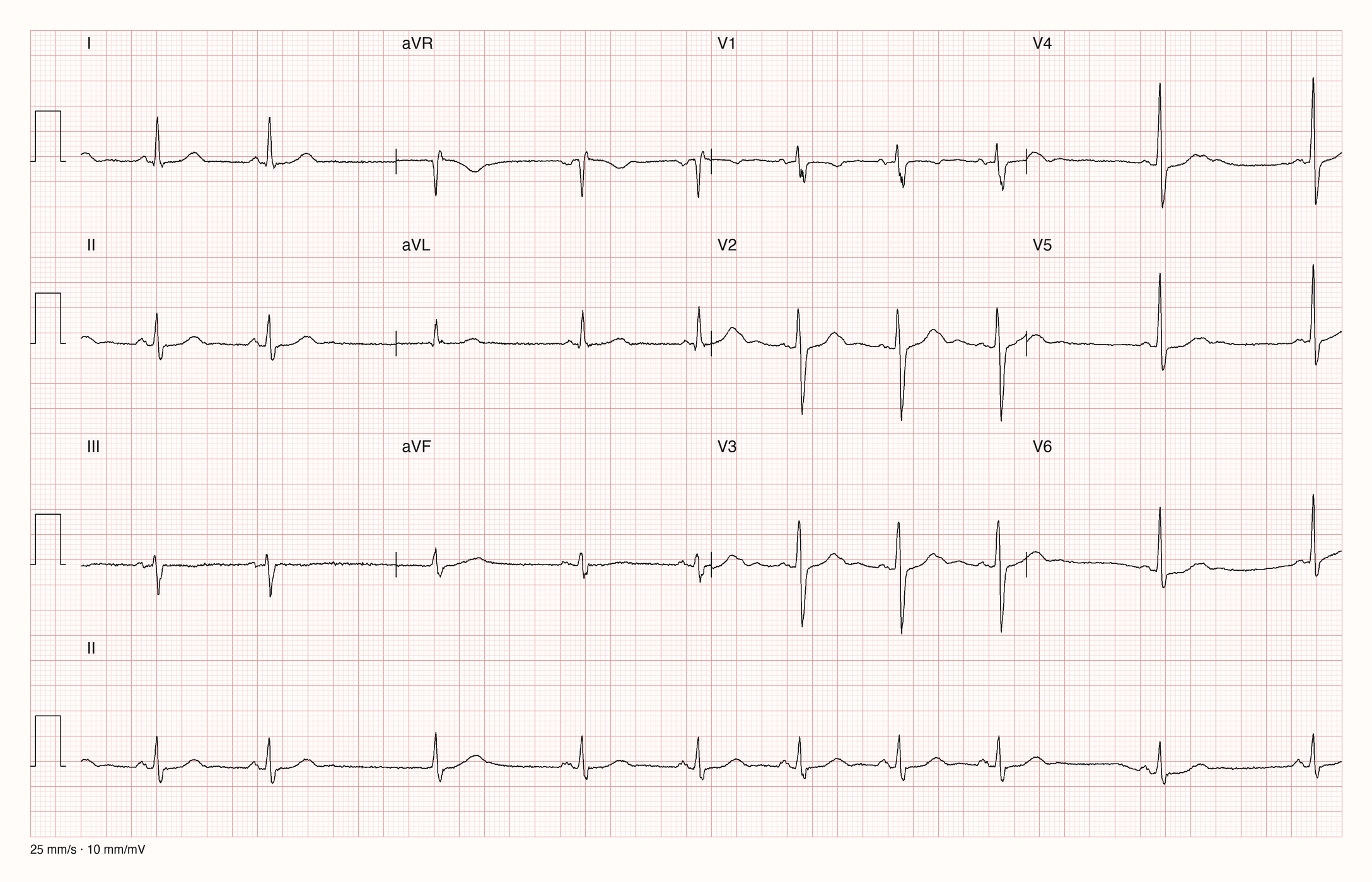 12-Kanal-EKG JS09293; zur systematischen Befundung