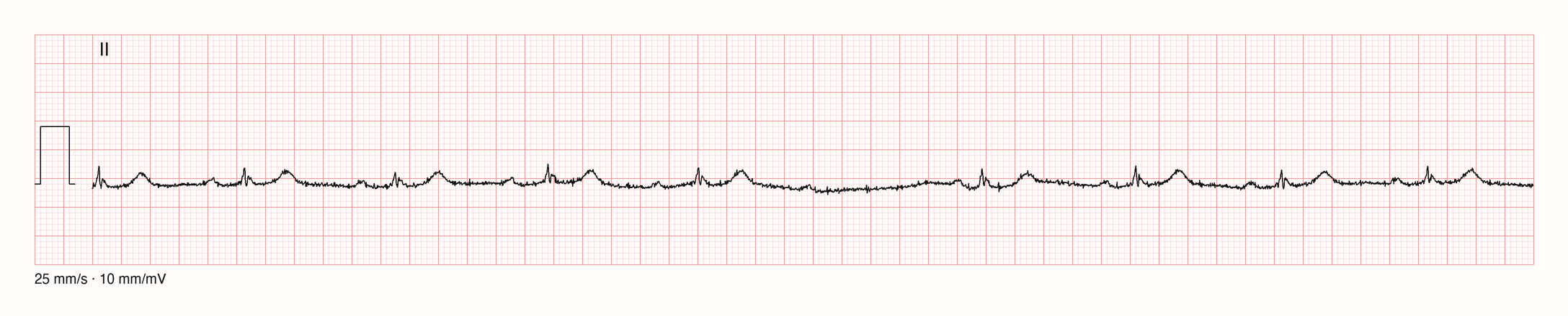 EKG-Aufnahme CHALLENGE-JS12426; beurteile zunächst selbst die sichtbare Kurve