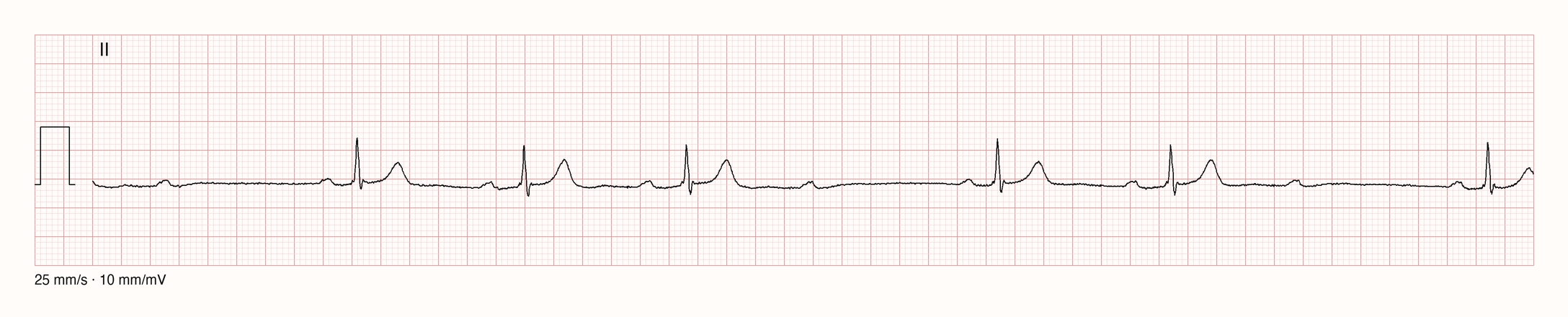 EKG-Aufnahme CHALLENGE-JS12440; beurteile zunächst selbst die sichtbare Kurve