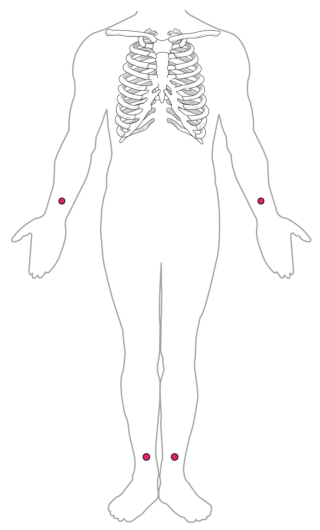Ganzkörperansicht von vorn mit den vier Extremitätenelektroden eines 12-Kanal-EKGs: je eine Elektrode symmetrisch an beiden distalen Unterarmen nahe dem Handgelenk und an beiden Unterschenkeln nahe dem Knöchel
