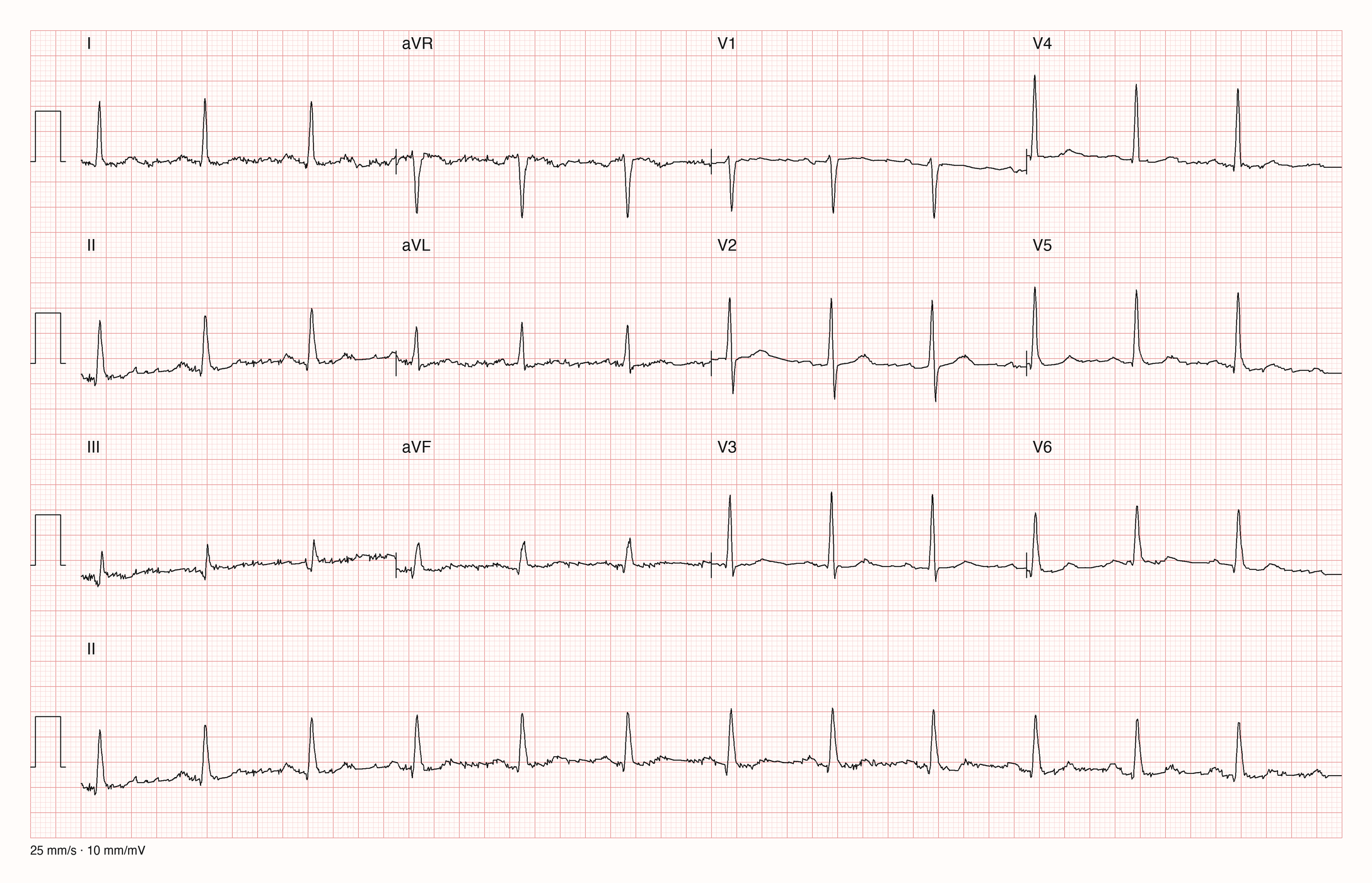 12-Kanal-EKG mit regelmäßigen schmalen QRS-Komplexen um 73/min; die T-Wellen sind in fast allen Ableitungen niedrig oder flach, das T-Ende ist in vielen Ableitungen schwer abzugrenzen