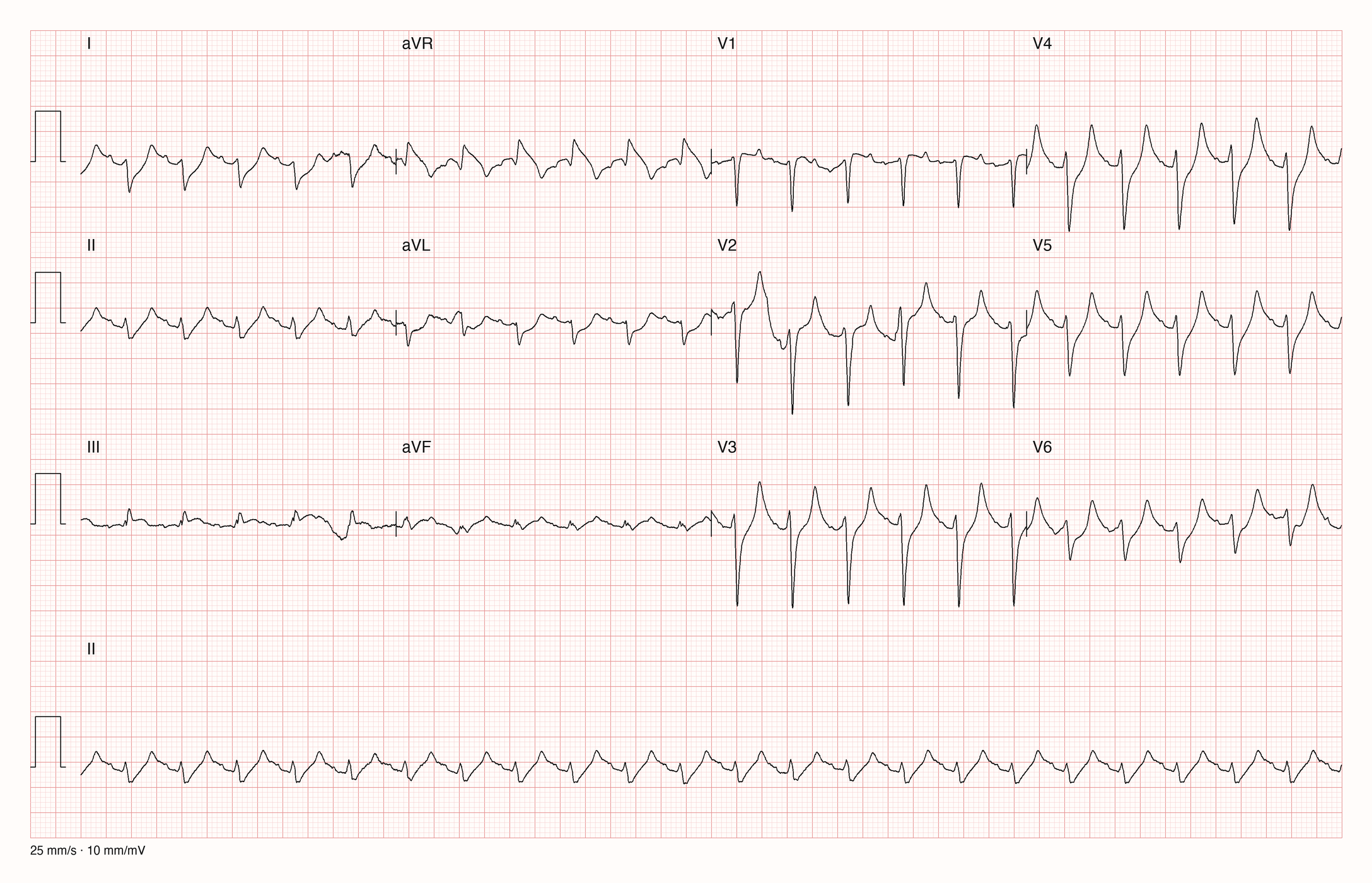 12-Kanal-EKG mit Rhythmusstreifen II: regelmäßige Tachykardie um 140/min, QRS-Komplexe ohne deutliche Verbreiterung; in V2 bis V6 hohe, schmalbasige, spitze und symmetrische T-Wellen, in V2 und V3 höher als die R-Zacke
