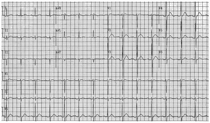 12-Kanal-EKG mit drei Rhythmusstreifen (V1, II, V5): regelmäßiger Rhythmus um 85/min, schmale QRS-Komplexe; in V2 und V3 beginnt die T-Welle unmittelbar am Ende des QRS, eine isoelektrische ST-Strecke ist dort kaum abgrenzbar