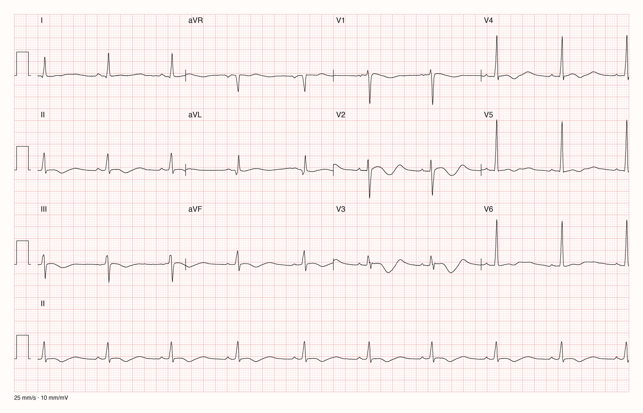 12-Kanal-EKG mit Rhythmusstreifen II: regelmäßiger Rhythmus um 55–60/min, schmale QRS-Komplexe; nach dem QRS in II, III und V5 eine flache, leicht negative Welle, danach eine breite positive Welle; in V2 und V3 eine deutliche negative Welle, gefolgt von einer breiten, hohen positiven Welle vor der nächsten P-Welle