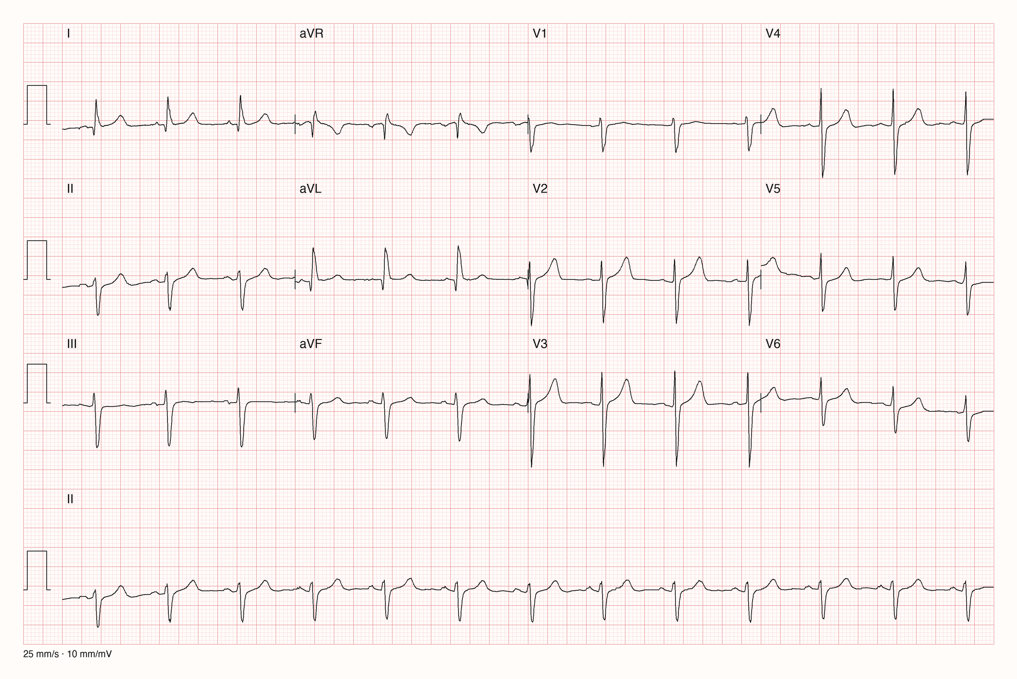 Ableitungen in 3×4-Anordnung mit II-Rhythmusstreifen: schmale QRS-Komplexe, qR in I und aVL, rS mit tiefem S in II, III und aVF