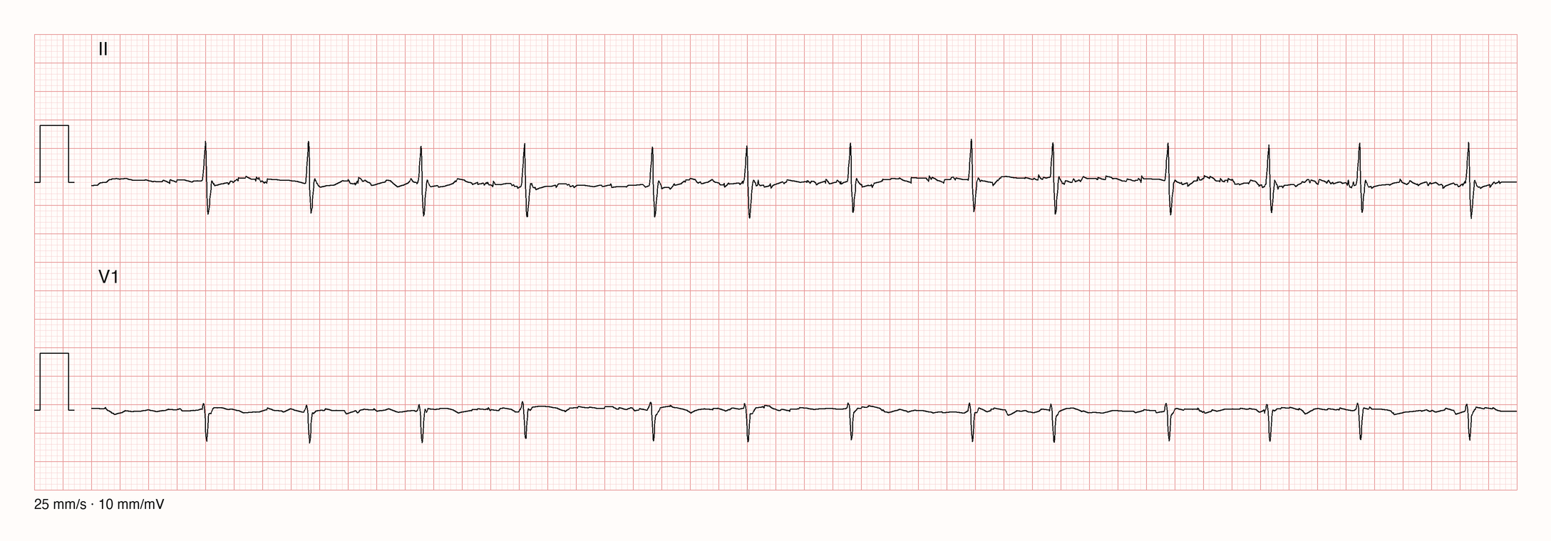 Rhythmusstreifen in Ableitung II und V1 über 10 Sekunden: schmale QRS-Komplexe in wechselnden Abständen ohne erkennbares Muster, dazwischen eine unruhige Grundlinie