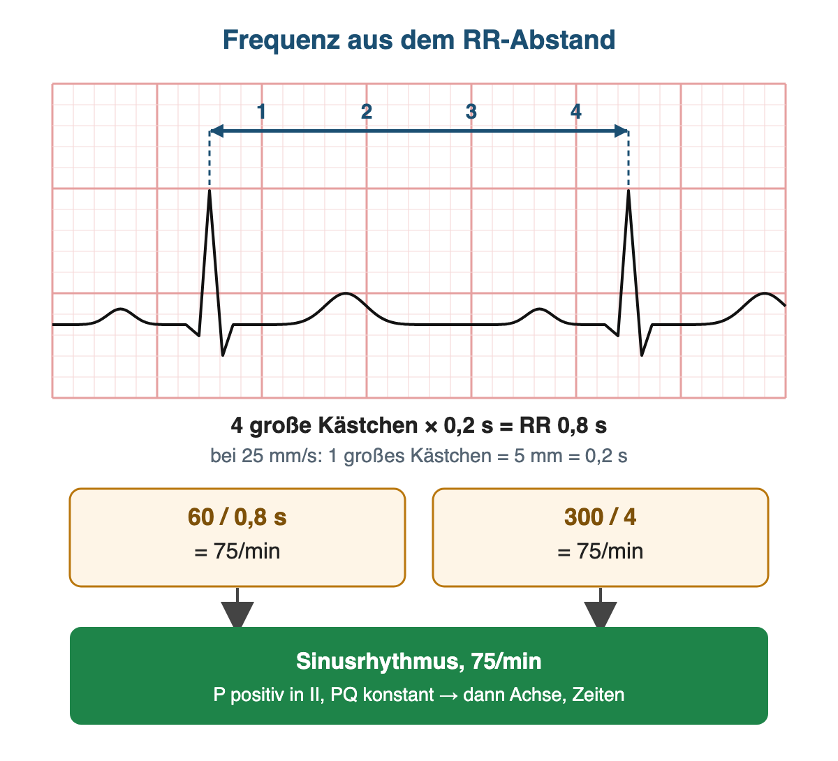 Ausgearbeitetes Beispiel auf EKG-Raster: zwei R-Zacken im Abstand von vier großen Kästchen, RR 0,8 s, 60/0,8 und 300/4 ergeben jeweils 75/min; Ergebnis Sinusrhythmus 75/min