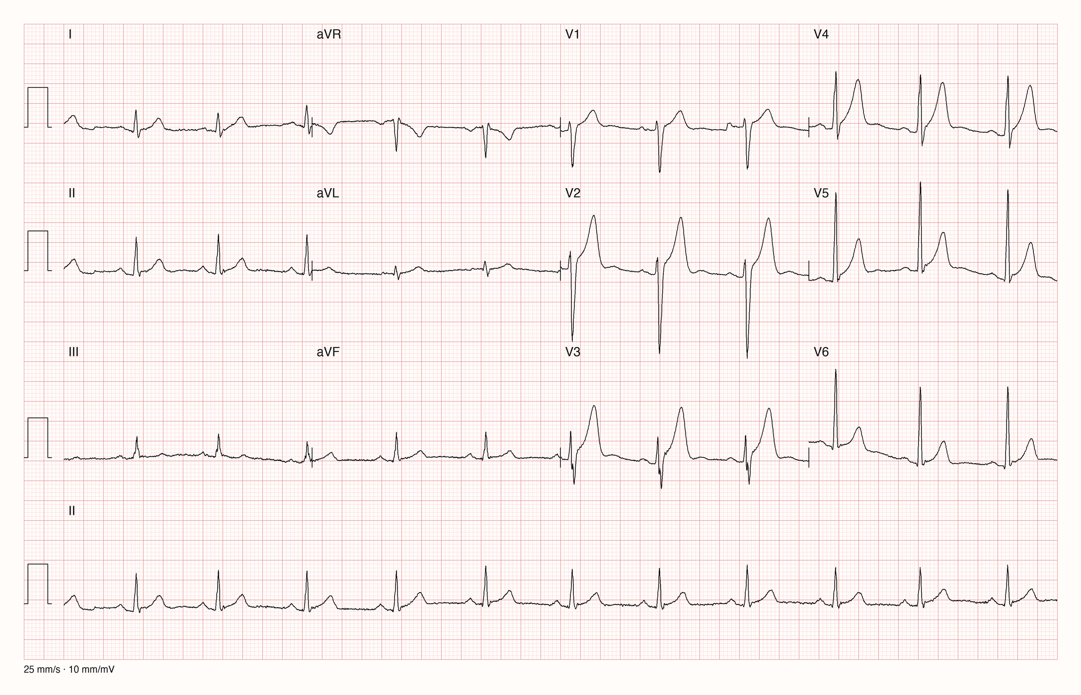 12-Kanal-EKG im Sinusrhythmus, etwa 68/min: J-Punkt und ST-Strecke in V2 bis V4 angehoben, konkav in hohe T-Wellen übergehend; in V4 und V5 angedeutetes Slurring am QRS-Ende; Extremitätenableitungen nahezu isoelektrisch