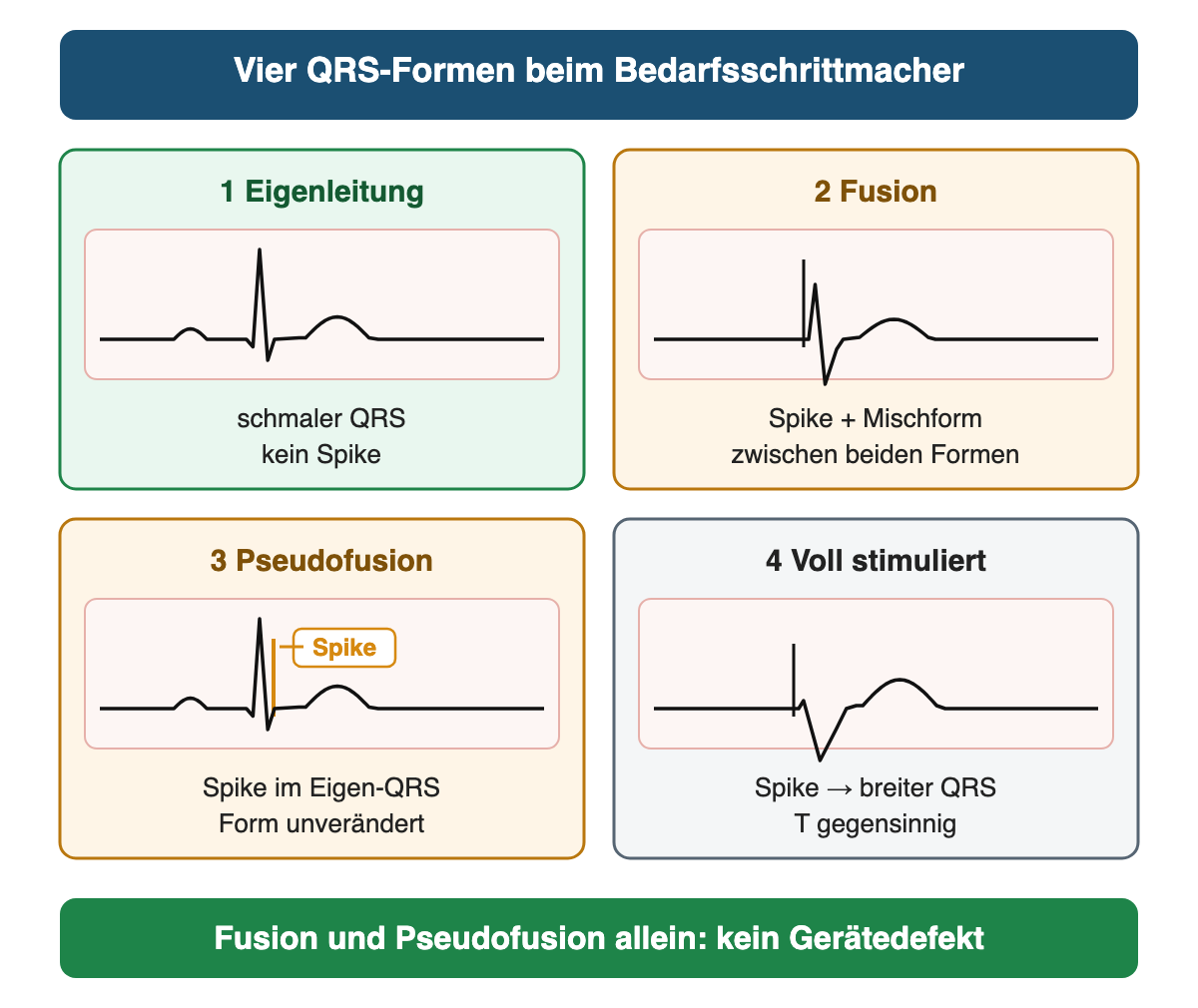 Vier QRS-Formen beim Bedarfsschrittmacher: Eigenleitung schmal ohne Spike; Fusion mit Spike und Mischform; Pseudofusion mit Spike im unveränderten Eigen-QRS; voll stimuliert mit Spike, breitem QRS und gegensinniger T-Welle; Fusion und Pseudofusion allein sind kein Gerätedefekt