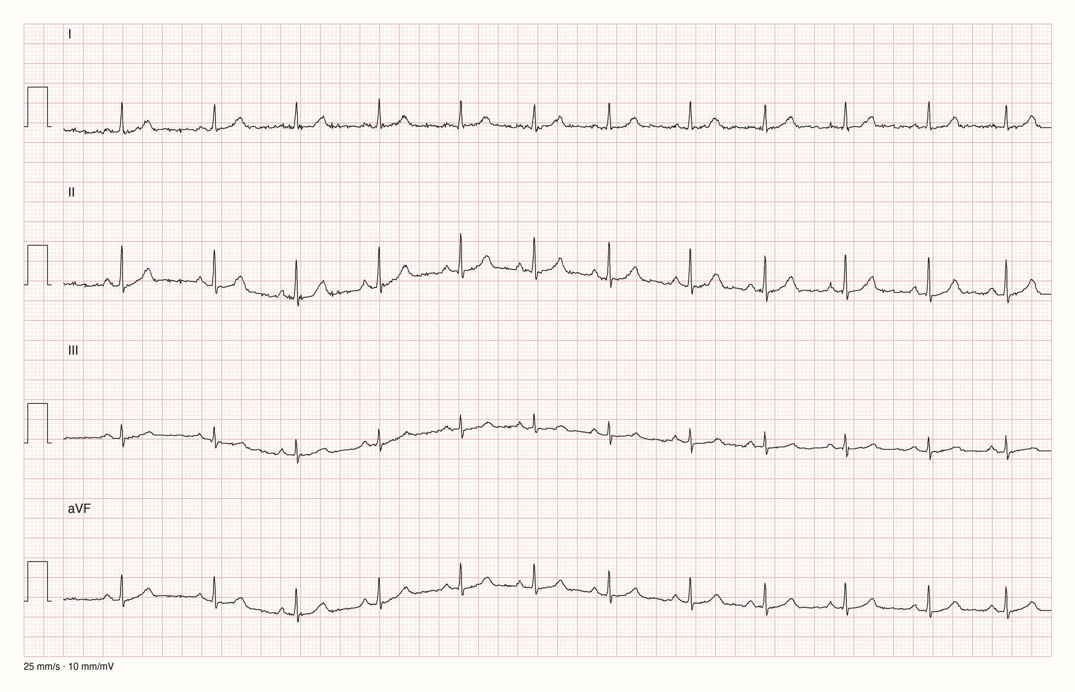 Ableitungen I, II, III und aVF über 10 s bei 25 mm/s und 10 mm/mV; die Grundlinie wandert in II, III und aVF langsam auf und ab, I bleibt fast ruhig; die QRS-Komplexe folgen regelmäßig
