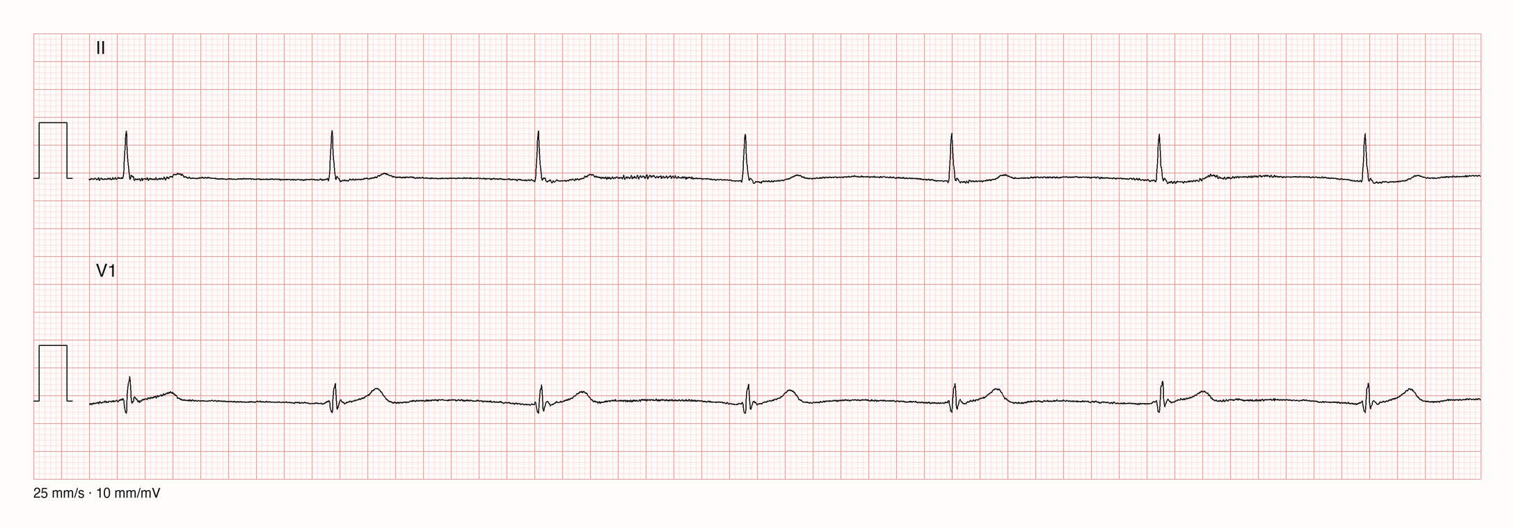 Rhythmusstreifen in Ableitung II und V1 über 10 Sekunden: regelmäßige, schmale QRS-Komplexe mit großem Abstand, vor und nach den QRS-Komplexen keine abgrenzbare P-Welle