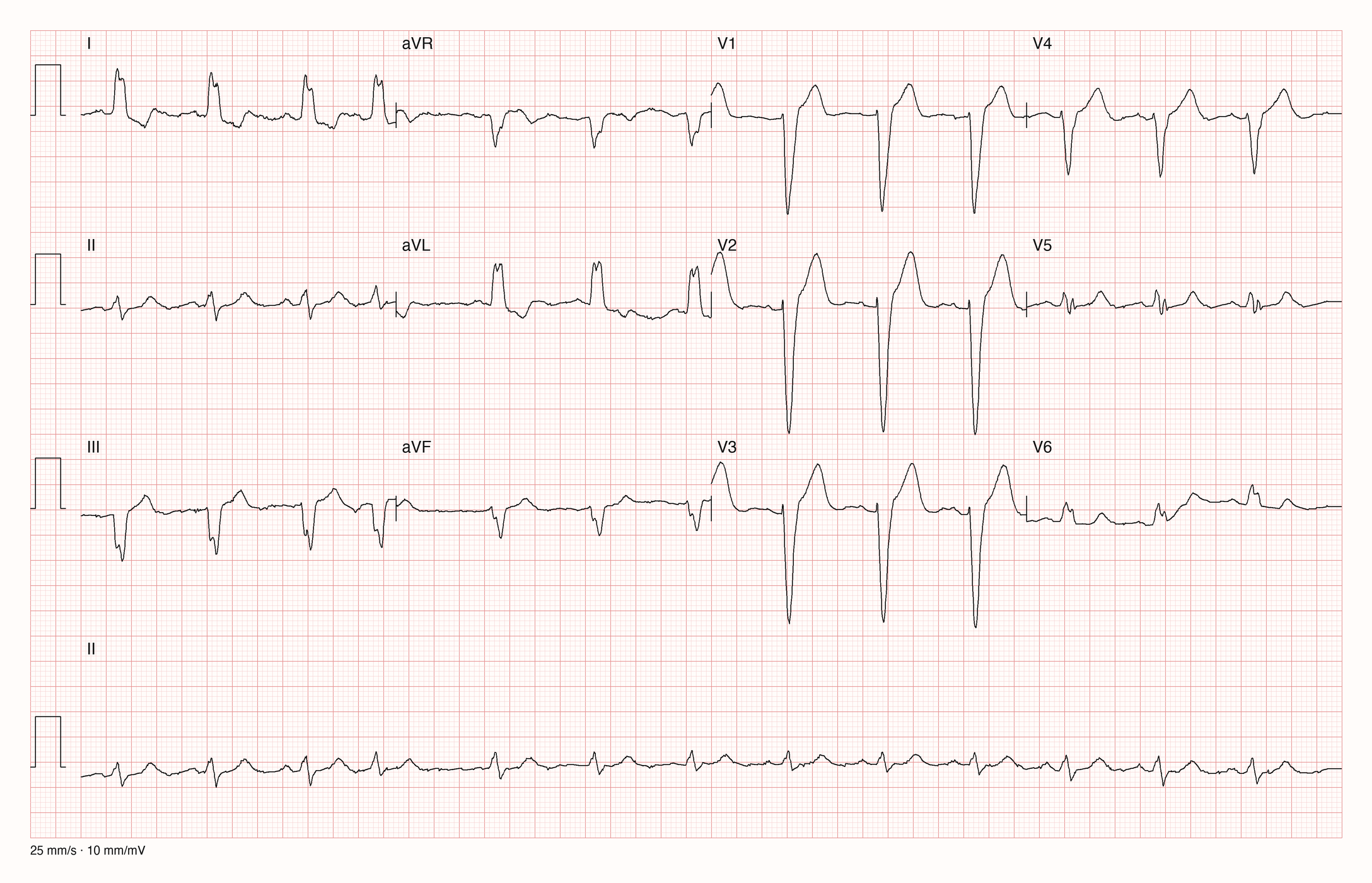 12-Kanal-EKG in 3×4-Anordnung mit II-Rhythmusstreifen: breite QRS-Komplexe, tiefe S-Zacken in V1–V3 mit kleiner ST-Hebung, breite gekerbte R-Zacken in I und aVL mit leichter ST-Senkung