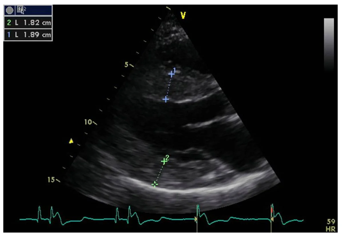 Echokardiografie, parasternale lange Achse: diffus verdicktes Kammerseptum und verdickte linksventrikuläre Hinterwand mit eingeblendeten Messstrecken 1,89 cm und 1,82 cm; unten EKG-Triggerkurve