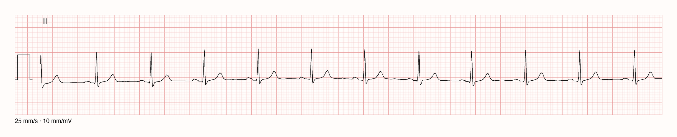 Ableitung II über 10 Sekunden: regelmäßige schmale QRS-Komplexe um 70/min, vor jedem QRS eine P-Welle