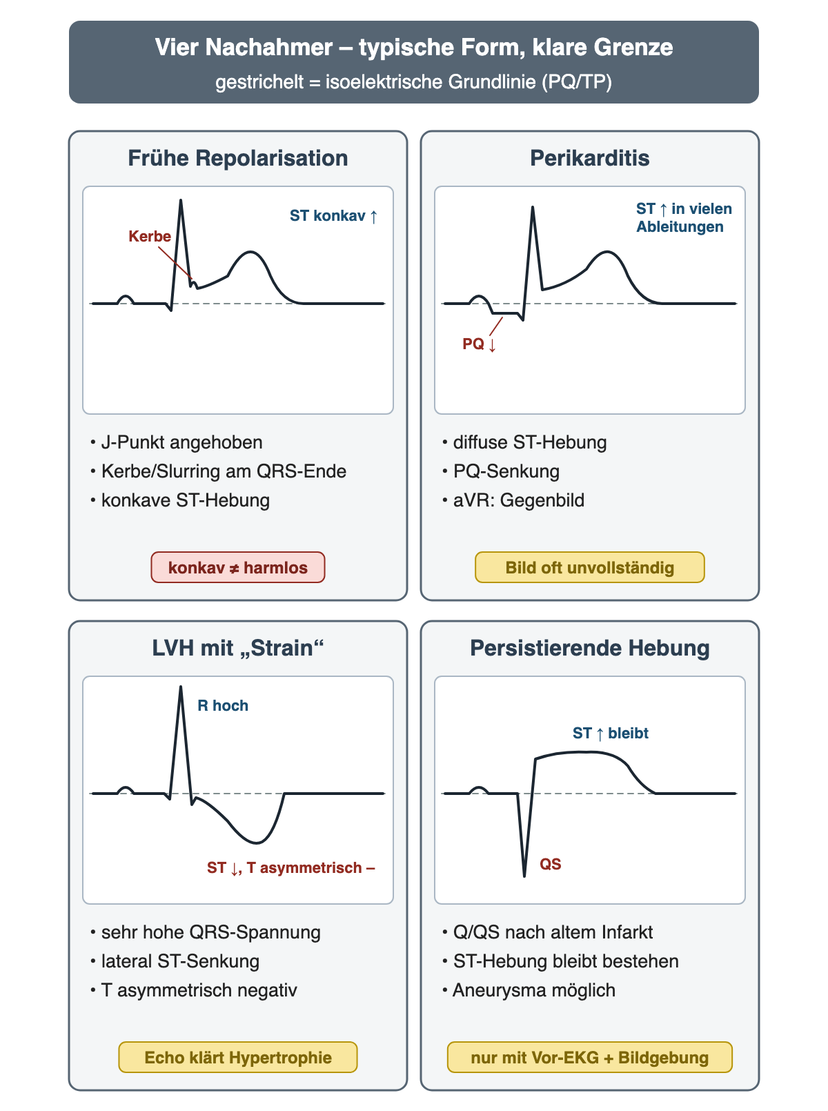 Vier schematische Komplexe mit gestrichelter Grundlinie: frühe Repolarisation mit Kerbe und konkaver ST-Hebung, Perikarditis mit PQ-Senkung und ST-Hebung, LVH mit hoher R-Zacke, absteigender ST-Senkung und asymmetrisch negativem T, persistierende Hebung mit QS-Komplex und anhaltender ST-Hebung; darunter je drei Merkmale und eine Grenze