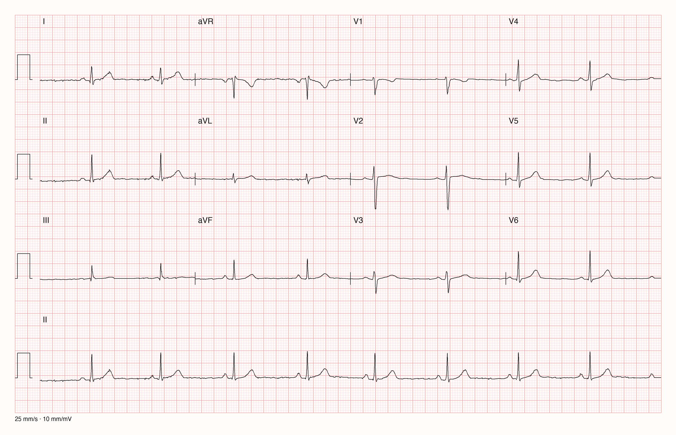Normales 12-Kanal-EKG im Sinusrhythmus mit negativem P, QRS und T in aVR und positiven Ausschlägen in II, V5 und V6
